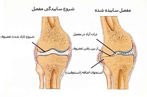 با این مواد غذایی غضروف سازی کنید!